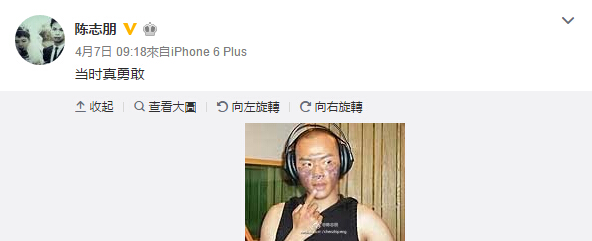 小帅虎陈志朋晒烧伤照 脸上全是疤(图)