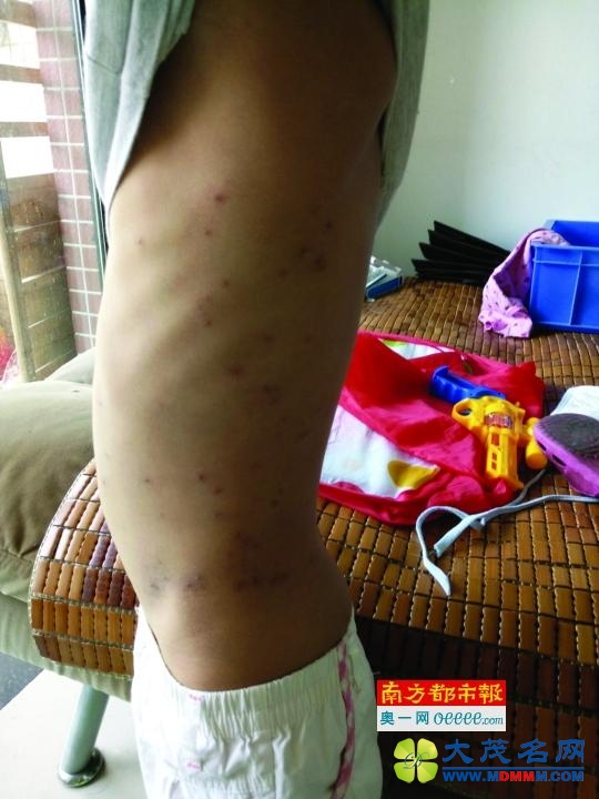 深圳一3岁男童疑在小区被跳蚤咬伤住院	