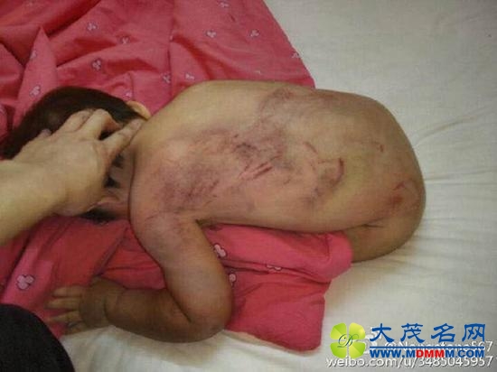 男子虐待女儿拍照炫耀 女童已送医嫌疑人被控制