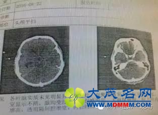 深圳男子被罕见“吃脑虫”侵入 十几天后病逝